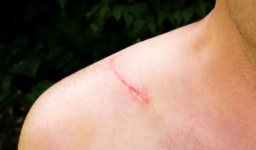 Jak ułatwić gojenie blizn? Pielęgnacja skóry po oparzeniu, zranieniu lub operacji