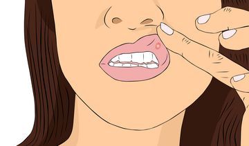 Czym są afty, jak je leczyć, czym różnią się od pleśniawek?