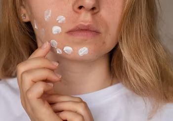 Krem wybielający to silnie działający krem na przebarwienia. Nakłada się go tylko punktowo.