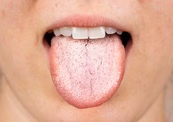 Biały nalot na języku może pokryć cały język albo pojawić się w postaci plam. Najczęściej wynika z zaniedbania higieny, niekiedy może być objawem grzybicy. Fot. Adobe Stock.