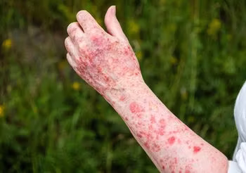 W przypadku fotodermatozy nawet po niewielkiej dawce słońca na skórze pojawiają się liczne zmiany, jak się rumień, wysypka, wyprysk.