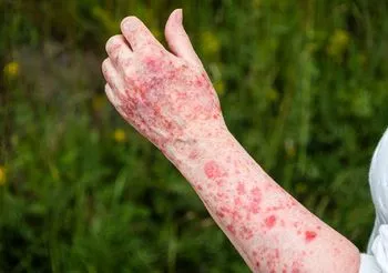 W przypadku fotodermatozy nawet po niewielkiej dawce słońca na skórze pojawiają się liczne zmiany, jak się rumień, wysypka, wyprysk.