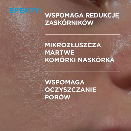 Idee Derm, serum przeciwtrądzikowe z kwasami, 30 ml - 5902082214793