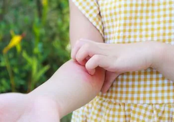 Swędząca wysypka może się pojawić na przykład w zgięciu łokci.