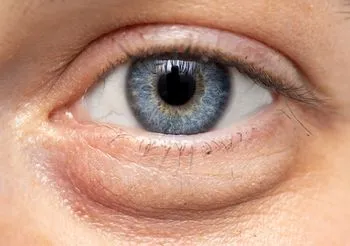 Wypukłe worki pod oczami to najczęściej objaw wiotczenia tkanek podskórnych, które przestają podtrzymywać tłuszcz obecny w oczodole. Fot. Adobe Stock.