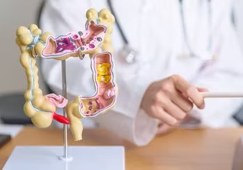 Kalprotektyna w kale to białko zlokalizowane w białych krwinkach, które wydzielane jest przez organizm w przypadku stanów zapalnych, ale nie tylko. /Fot. Adobe Stock