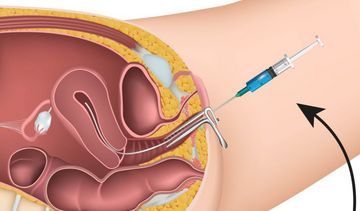 Inseminacja domaciczna – przygotowanie i przebieg