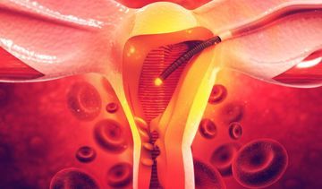 Czym jest inseminacja domaciczna?