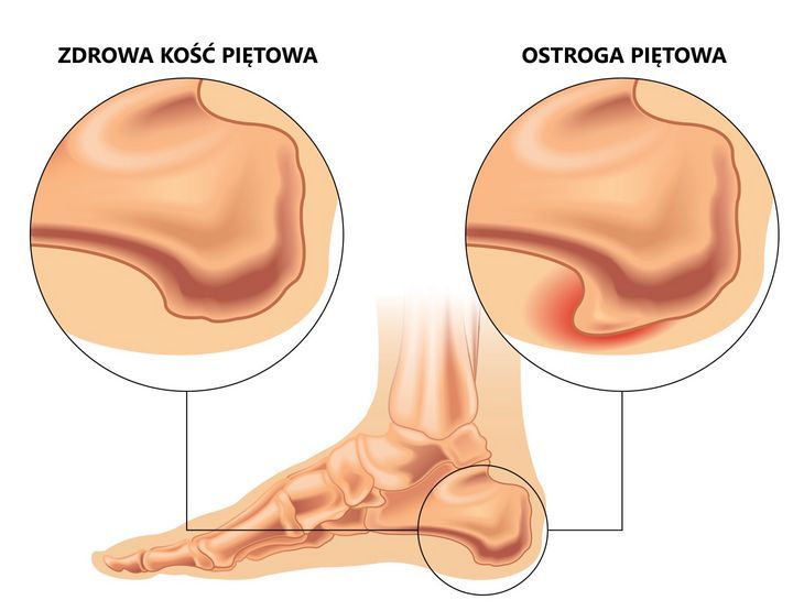 Ostroga piętowa to maleńkie wyrostki kostne tworzące się na kości piętowej. Często nie dają objawów, ale zdarza się, że sprawiają ogromny ból.