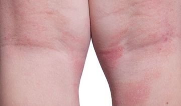 Objawy atopowego zapalenia skóry