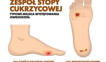 Stopa cukrzycowa – jak uniknąć tego powikłania?