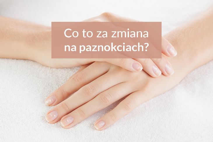Wygląd paznokci a zdrowie, czyli o czym informują nas zmiany na paznokciach