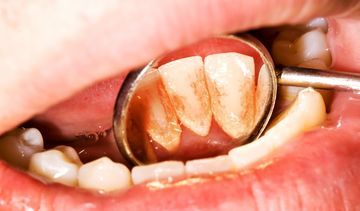 Kamień na zębach - przyczyny i zapobieganie. Jak usunąć kamień z zębów?
