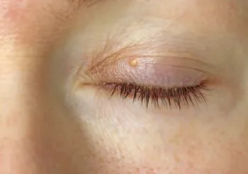 Kaszak powstaje w wyniku zablokowania mieszków włosowych lub kanalików gruczołów łojowych. Pojawia się zwykle u dorosłych, często na twarzy. Fot. Adobe Stock.