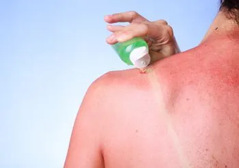 Co stosować na oparzenia słoneczne? W przypadku oparzeń słonecznych I stopnia ulgę przyniesie smarowanie poparzonych miejsc preparatami z aloesem.