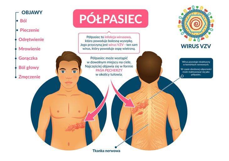Półpasiec – objawy, leczenie. Jak boli półpasiec, czy jest zaraźliwy?