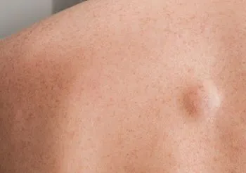 Tłuszczak zwykle jest owalny lub okrągły, rośnie powoli do kilku centymetrów średnicy. Powstaje głęboko w tkance podskórnej, więc nie zmienia barwy skóry nad nim. Fot. Adobe Stock.