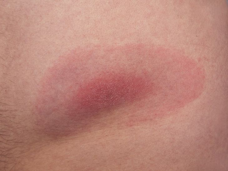 Rumień po kleszczu przybiera postać rozległego (powyżej 5 cm średnicy) zaczerwienienia wokół miejsca wkłucia kleszcza, widać na nim wysypkę.