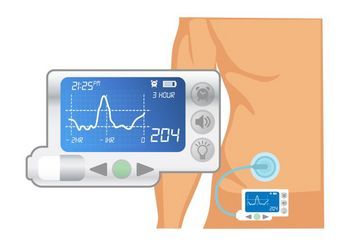rysunek osobistej pompy insulinowej przypiętej do brzucha pacjenta za pomocą wkłucia