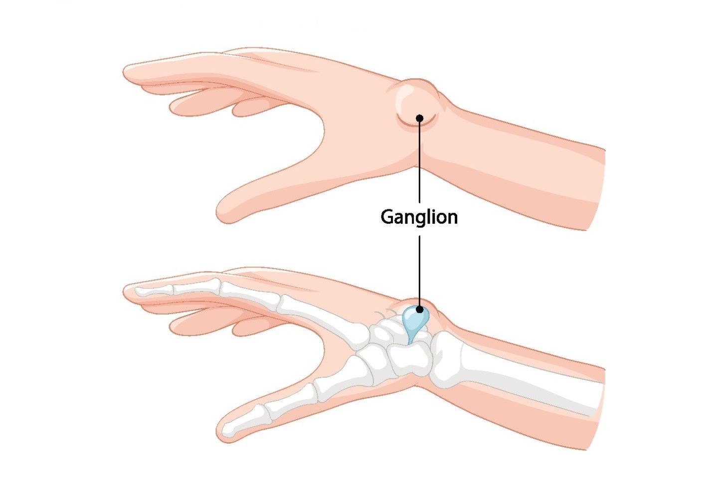 Ganglion Czym Jest Torbiel Galaretowata Leczenie Ganglionu ganglion-czym-jest-torbiel-galaretowata-leczenie-ganglionu