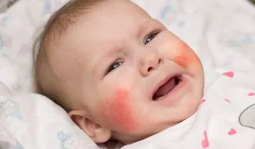 Nie pomyl atopowego zapalenia skóry z innymi chorobami
