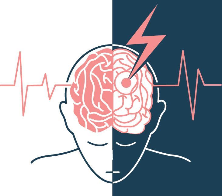 Udar mózgu – objawy udaru niedokrwiennego i krwotocznego (wylewu). Pierwsza pomoc przy udarze