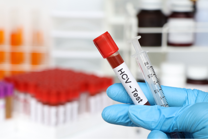 Badanie HCV to badanie krwi umożliwiające wczesne wykrycie zakażenia wirusem odpowiedzialnym za zapalenie wątroby typu C. /Fot. Adobe Stock