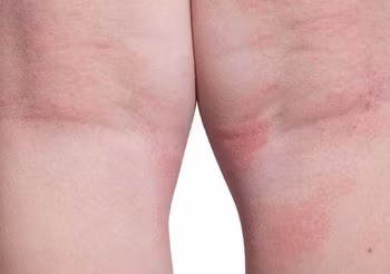 dziecięce nóżki ze skórnymi zmianami atopowymi