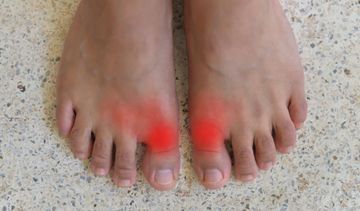 Dna moczanowa (podagra, artretyzm) – objawy, leczenie. Jaka dieta przy dnie moczanowej?