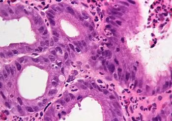 Do niedawna chorobę wrzodową tłumaczono stresem i złą dietą. Dziś już wiemy, że czynniki te jej nie wywołują, a jedynie zaostrzają. Prawdziwym winowajcą jest Helicobacter pylori, bakteria, która uszkadza błonę śluzową żołądka i dwunastnicy.