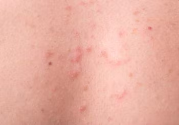 Trądzik grzybiczy to małe czerwone grudki i krosty szczególnie na plecach.