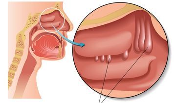 Polipy w nosie – rodzaje, leczenie i operacja usuwania polipów