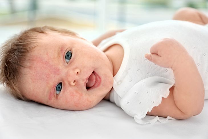 Alergia pokarmowa u niemowlaka – objawy i leczenie