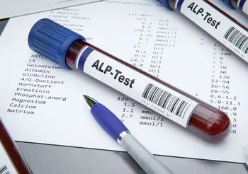 Fosfataza zasadowa (alkaliczna) oznaczana w badaniach jako ALP, to enzym, który odpowiedzialny jest przede wszystkim za usuwanie pirofosforanów, czyli związków hamujących prawidłowy wzrost kości. /Fot. Adobe Stock