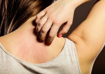 Nietolerancja histaminy objawia się oporną na leczenie wysypką