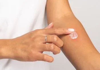 Jeśli pieczenie skóry wynika z podrażnienia substancjami chemicznymi lub z wrażliwości skóry, można sięgnąć po łagodzące kosmetyki z aloesem, alantoiną  i wodą termalną.