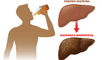 Marskość wątroby - objawy, leczenie, rokowanie