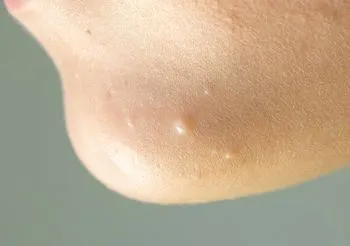 Mięczak zakaźny występuje głównie u dzieci w wieku przedszkolnym i szkolnym. U dziecka charakterystyczne perłowe guzki zwykle pojawiają się na kończynach i tułowiu, rzadziej na twarzy. Fot. Adobe Stock.